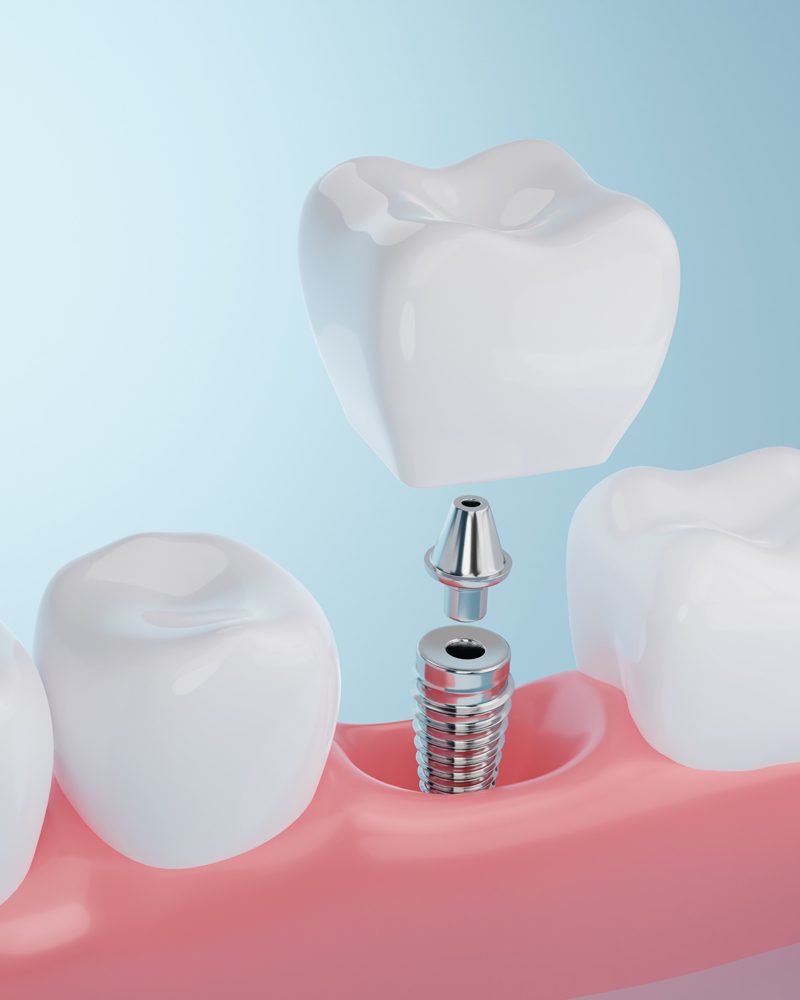 Dental Implants in Louisville, KY